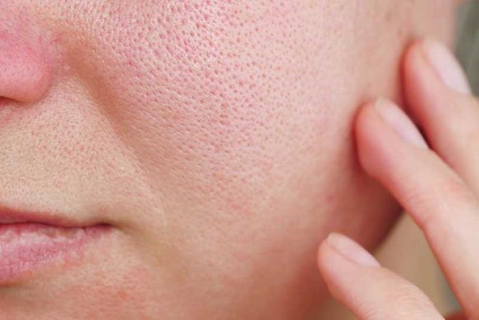 Minimizing Enlarged Pores: Your Skin Solution