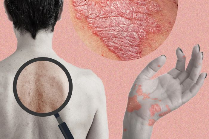Can Panchakarma Cure Your Eczema?